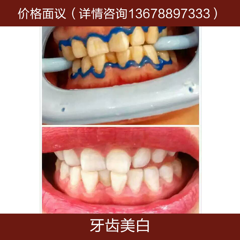 供應牙齒美白 冷光美白牙齒 藍光美白 炫齒美白加盟培訓課程