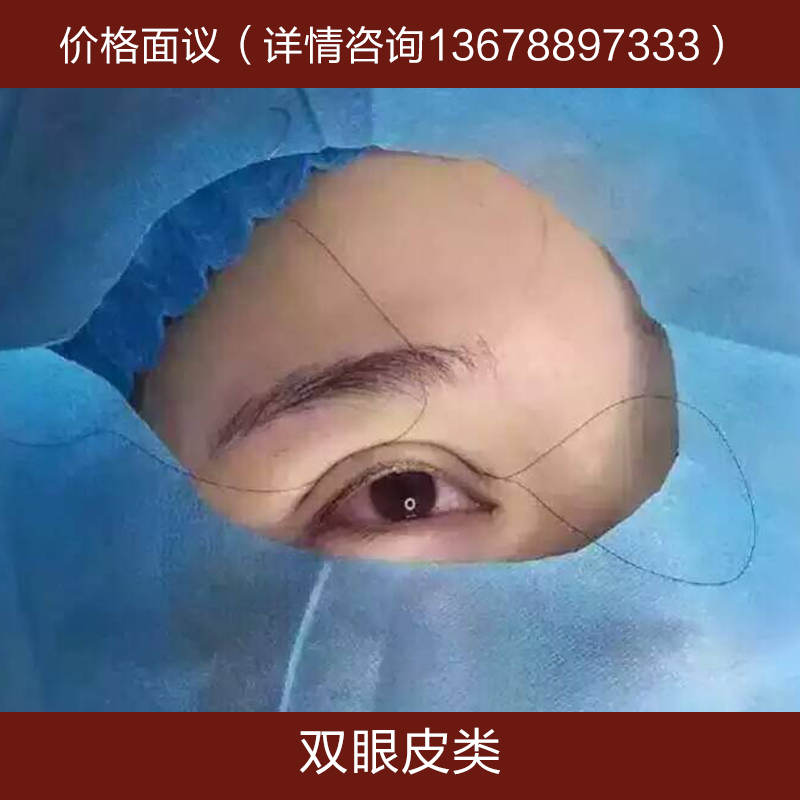 雙眼皮圖片/雙眼皮樣板圖 (2)