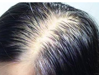 重慶植發(fā)多少錢？圖片