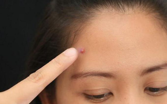 祛痘方法圖片