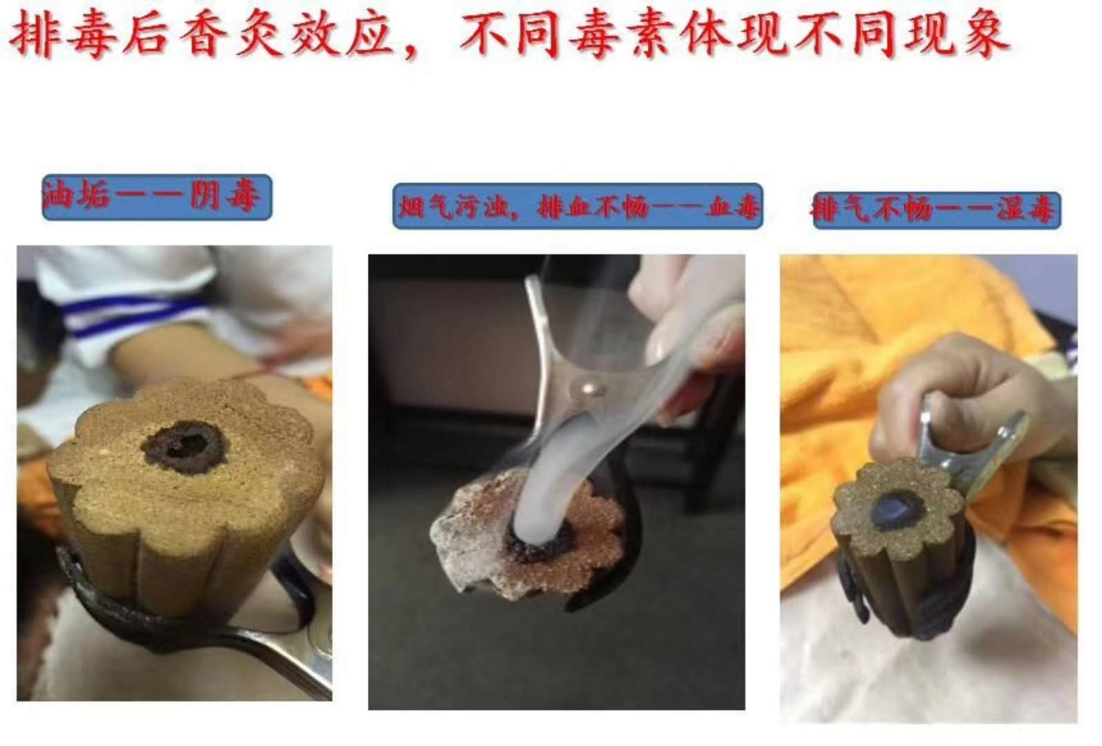 三伏灸圖片/三伏灸樣板圖 (2)