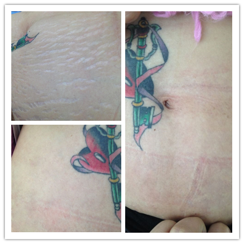 武漢紋管家專業(yè)修復(fù)*—*修復(fù)選擇紋管家