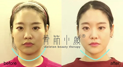 山東皮膚管理培訓選骨筋小顏 健康
