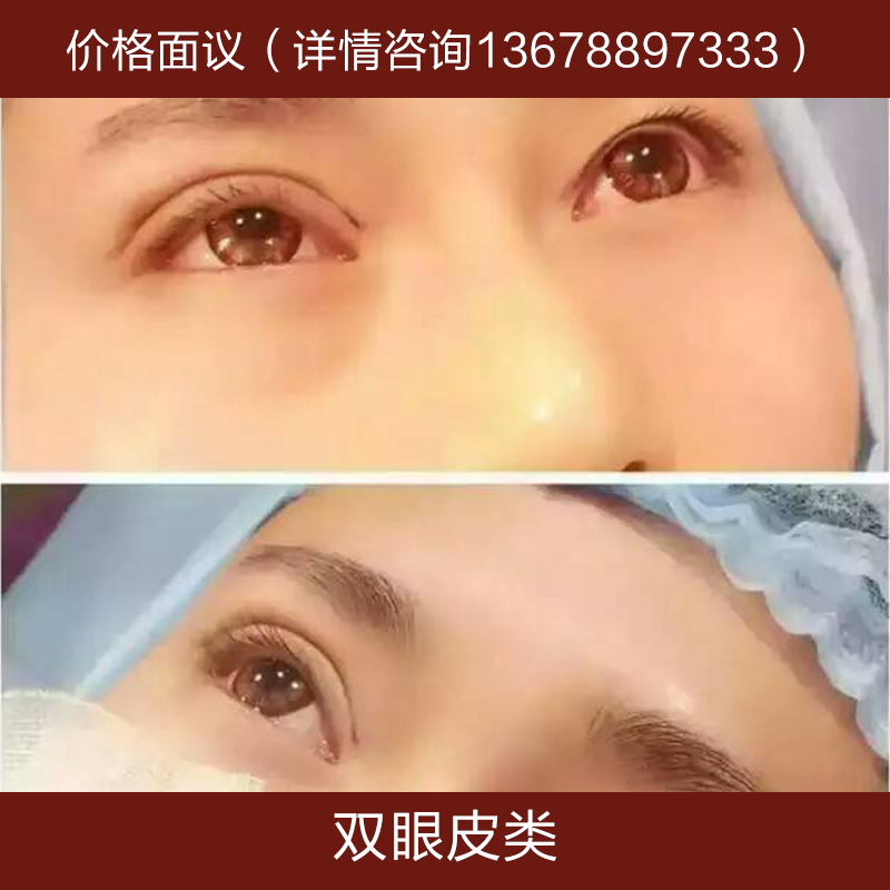 供應(yīng)雙眼皮類 平行雙眼皮 埋線雙眼皮 割雙眼皮 祛眼袋