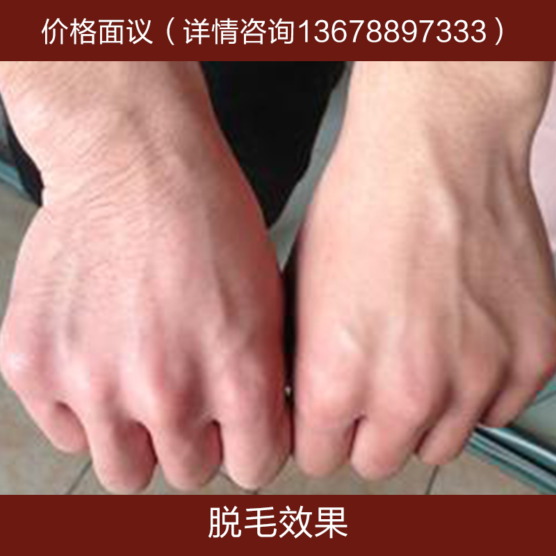 供應(yīng)脫毛效果 *脫毛 美容美體 激光脫毛 脫毛培訓(xùn) 脫毛報(bào)價(jià)