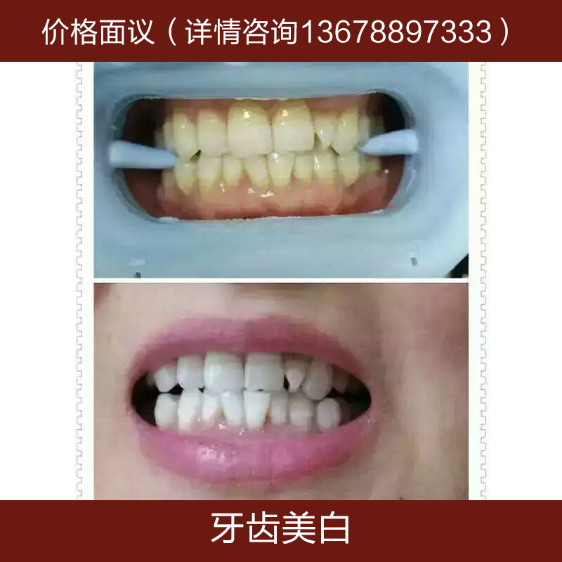 供應牙齒美白 冷光美白牙齒 藍光美白 炫齒美白加盟培訓課程