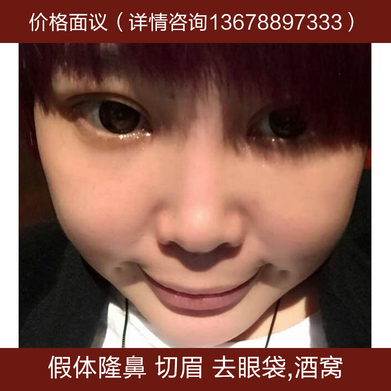 供應(yīng)假體隆鼻 切眉 去眼袋 酒窩 豐額頭 隆下巴 各類美容項目供應(yīng)