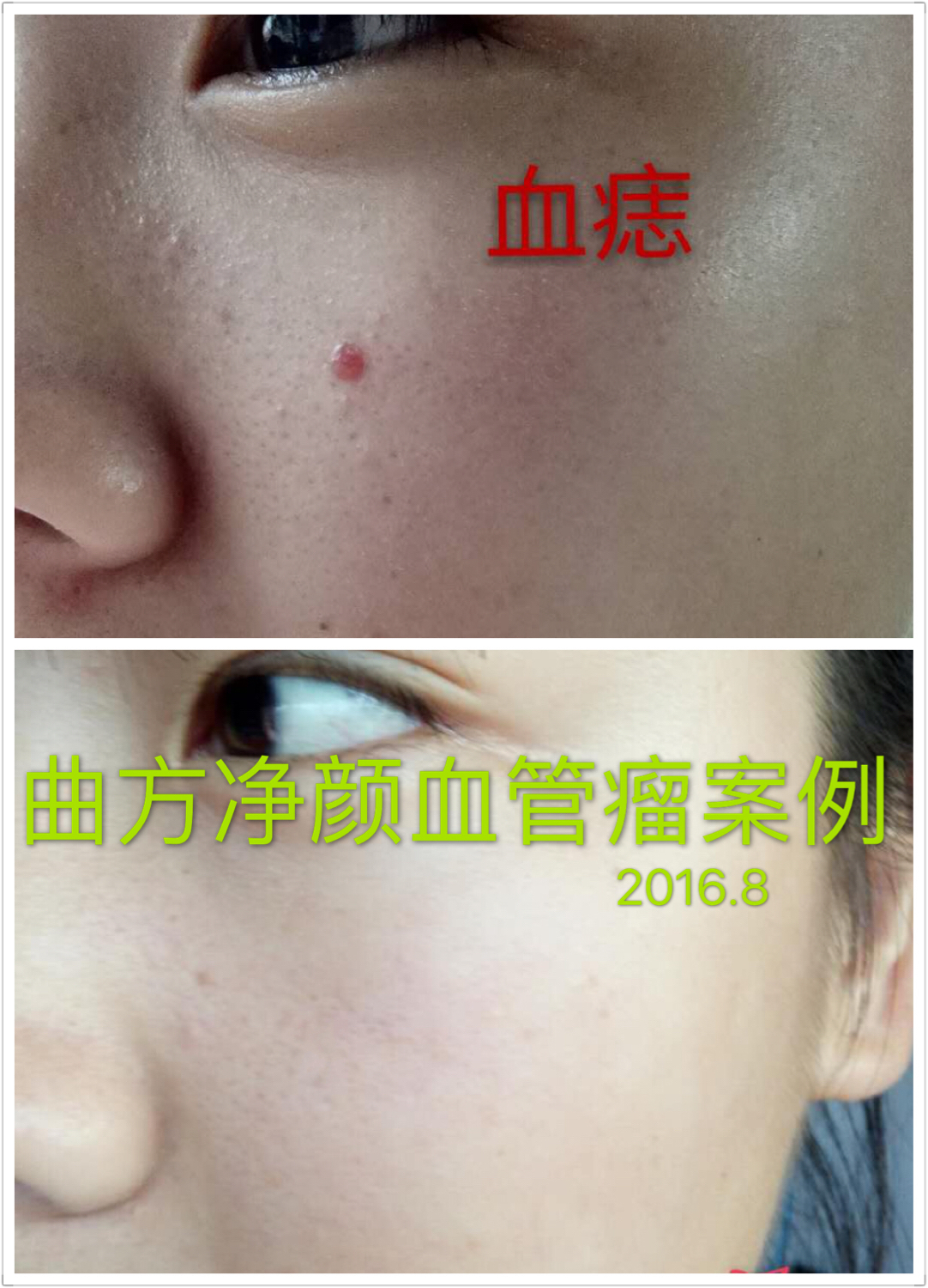 曲方凈顏祛斑*祛痘