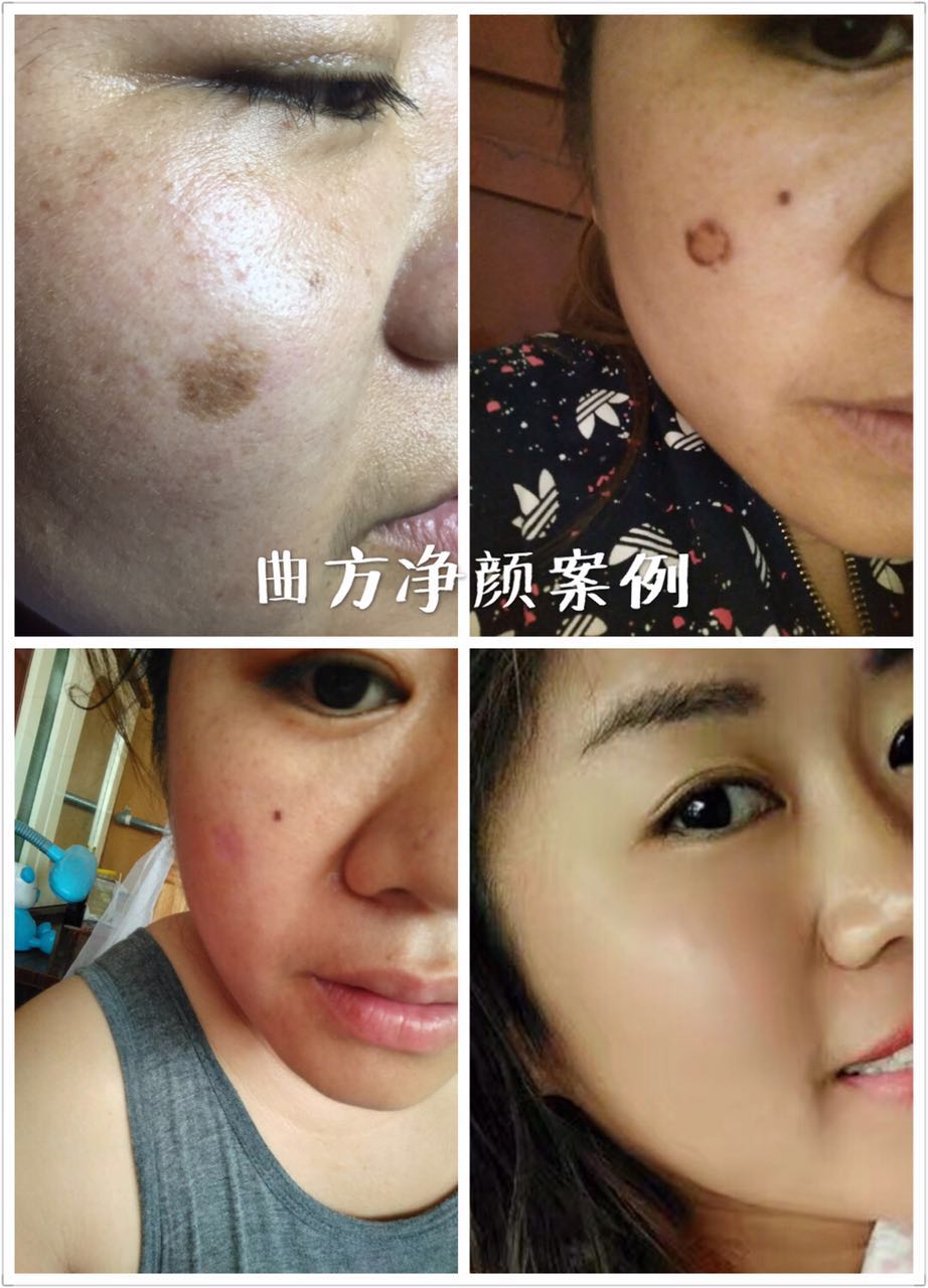 祛痘 祛斑