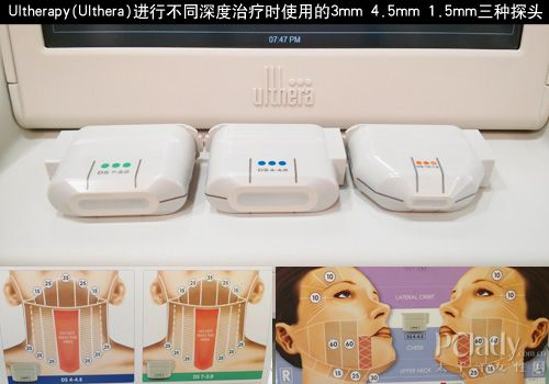 進(jìn)口超聲刀Ulthera新探頭供應(yīng)商，美版超聲刀新探頭加盟