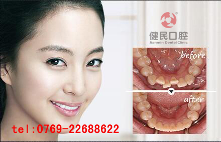 東莞隱形牙齒正畸價格