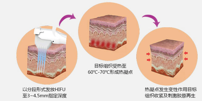 美版塑型超聲刀的效果和報(bào)價(jià)