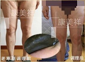 為何女性多會有宮寒呢？宮寒怎么辦