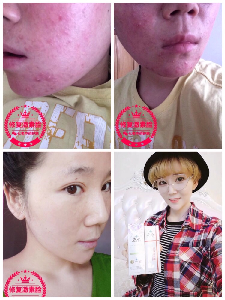 都是*臉惹的禍，差點(diǎn)毀了我的一切、幸虧有它讓我恢復(fù)了自信 七老親肌嫩膚系列