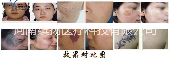 YAG光電調(diào)Q激光美容儀器，去除各種色素肌膚問題
