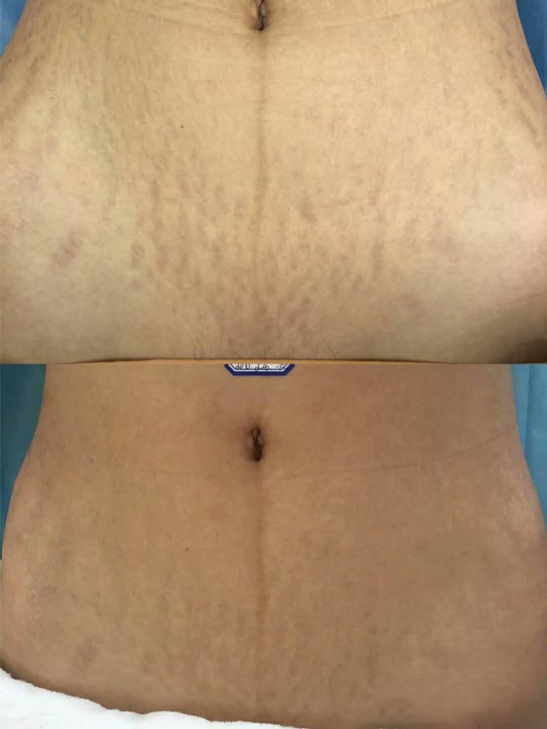 武漢*哪里修復(fù)好—武漢紋管家