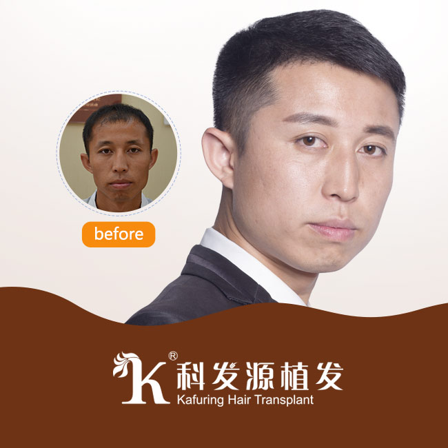株洲哪里有植發(fā)的