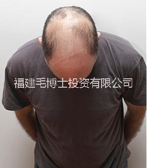 福州植發(fā)*禿頂植發(fā)費用是多少