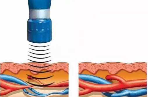 沖擊波疼痛治儀作用原理