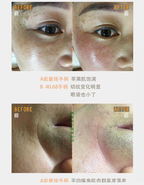 以色列維美肌paa抗衰機器人熱拉提瑪吉美容面部抗衰儀器