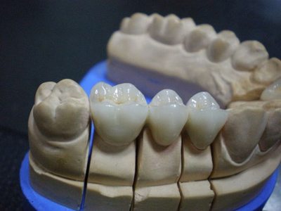 深圳二品牌牙套,牙套工廠,正畸牙套,正畸矯治牙套,矯治牙套,生產(chǎn)廠家