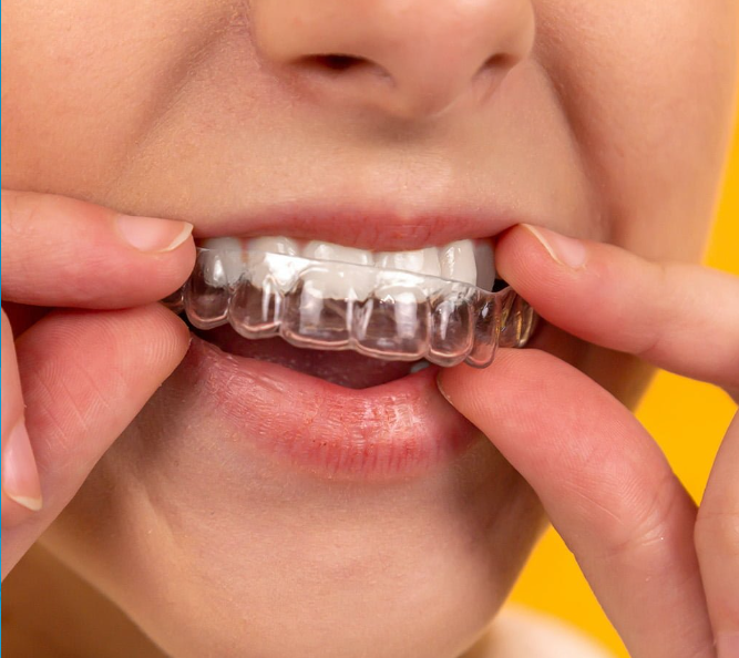 中國(guó)工廠牙齒牙齒矯正器牙齒正畸